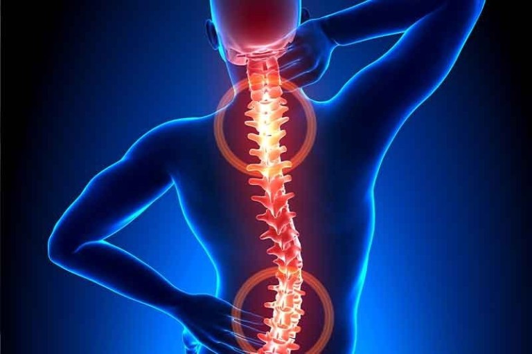 Cervical Superior: Un tratamiento natural para ayudar a la escoliosis