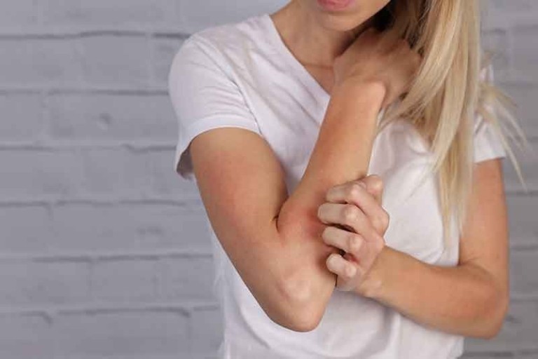 Cómo tratar naturalmente el prurito braquioradial
