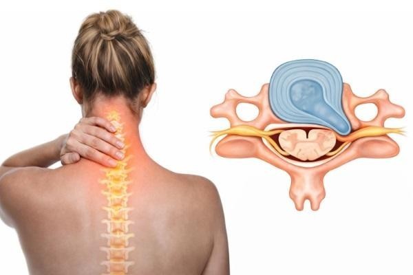 Cervical Herniated Disc: Symptoms and Relief