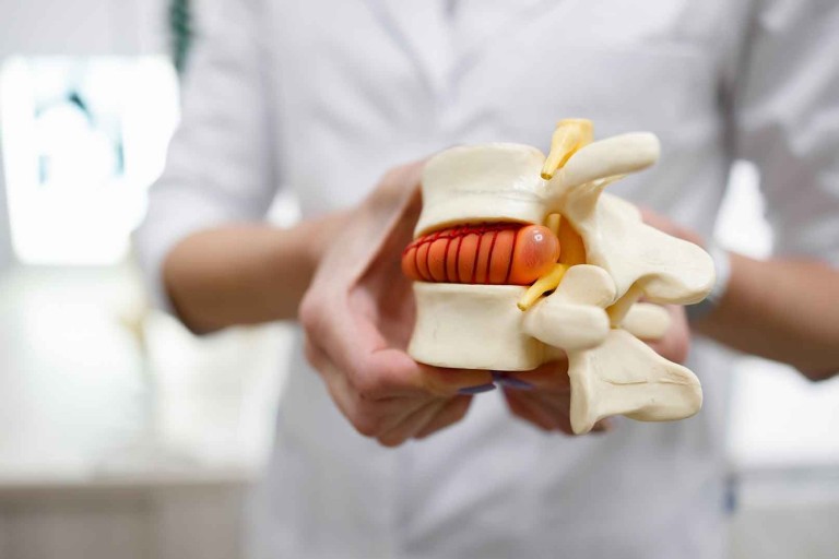 Hernia discal y atención quiropráctica